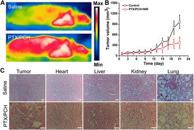 Redox-responsive hyaluronan-conjugated polypyrrole nanoparticles targeting <mark class="highlighted">chemo-photothermal therapy</mark> for breast cancer